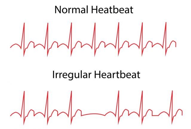 Prognosis and Treatment of Abnormal Heartbeats | CPR TO GO Training Center